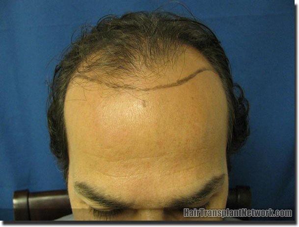 Hair restoration procedure results