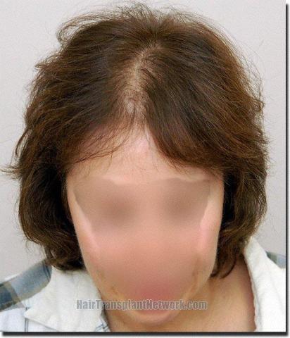 Hair restoration procedure results