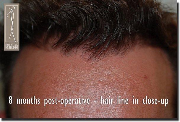 Hair restoration procedure results