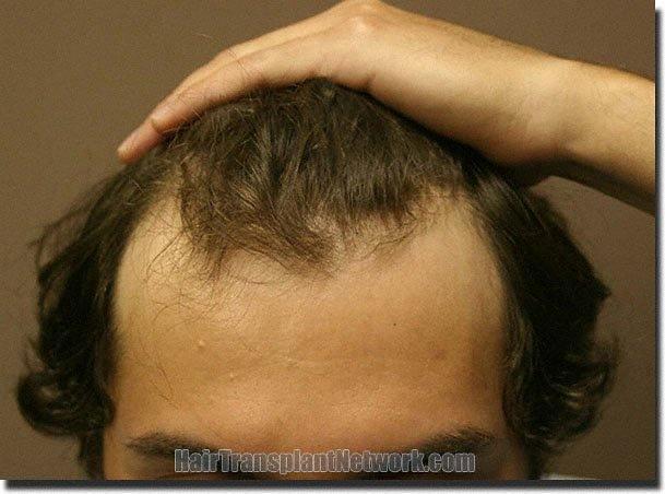 Hair restoration procedure results