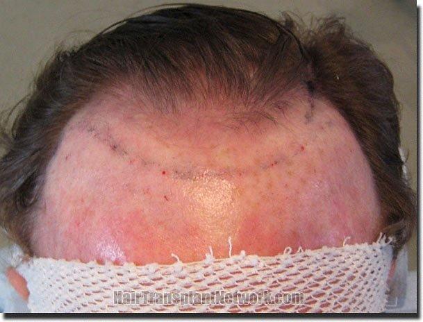 Hair restoration procedure results