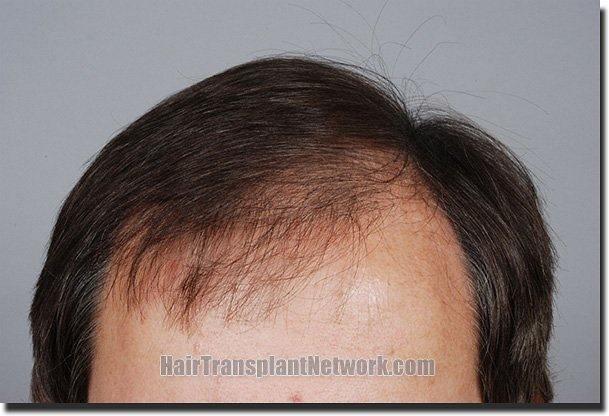 Hair restoration procedure results