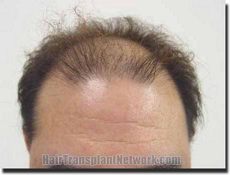 Hair restoration procedure results