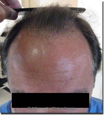 Hair restoration procedure results