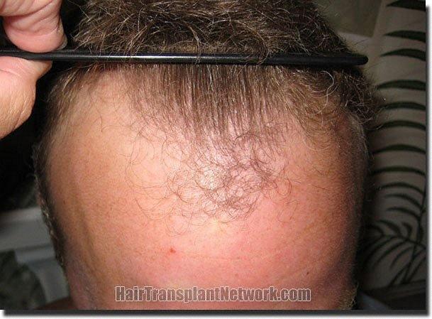 Hair restoration procedure results