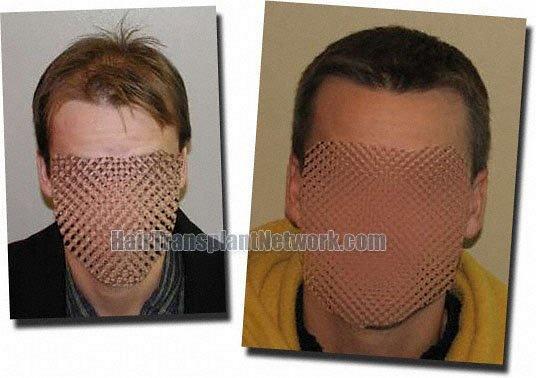 Hair restoration procedure results