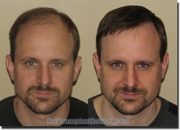 Hair restoration procedure results