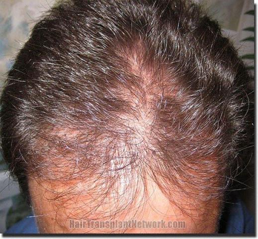 Hair restoration procedure results