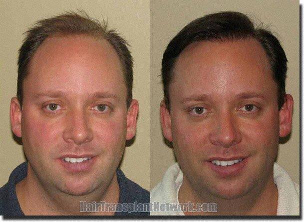 Hair restoration procedure results