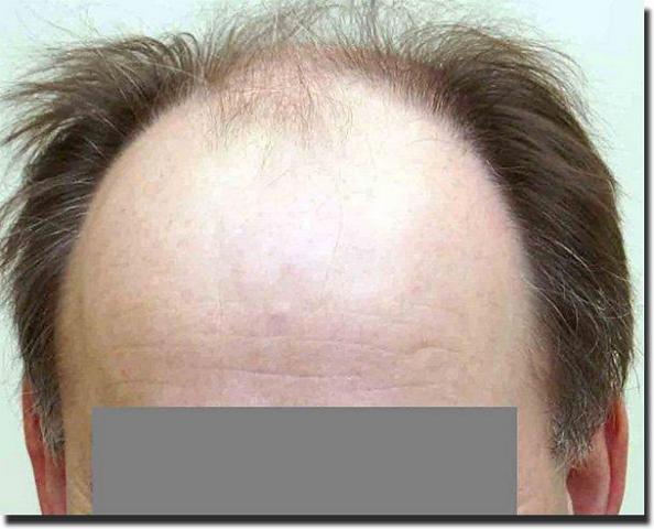 Hair restoration procedure results