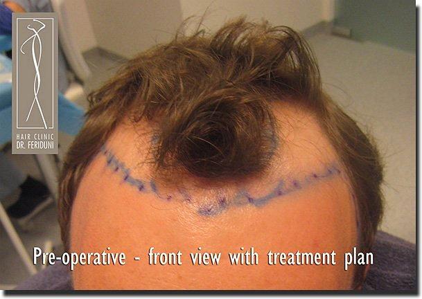 Hair restoration procedure results