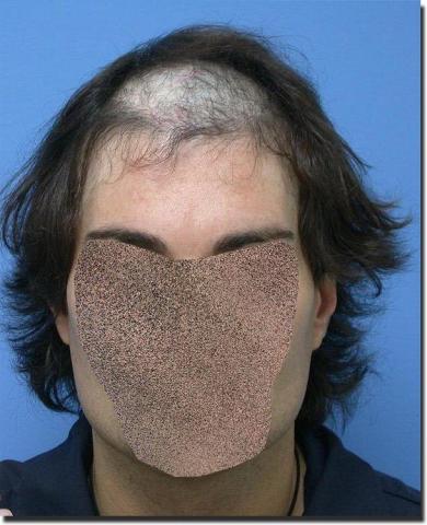 Hair restoration procedure results