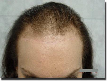 Hair restoration procedure results