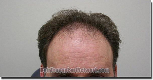 Hair restoration procedure results