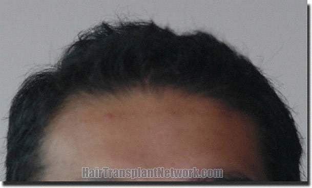 Hair restoration procedure results