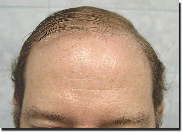 Hair restoration procedure results