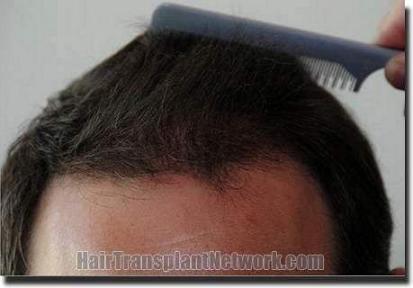 Hair restoration procedure results