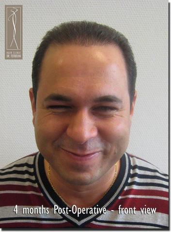 Hair restoration procedure results