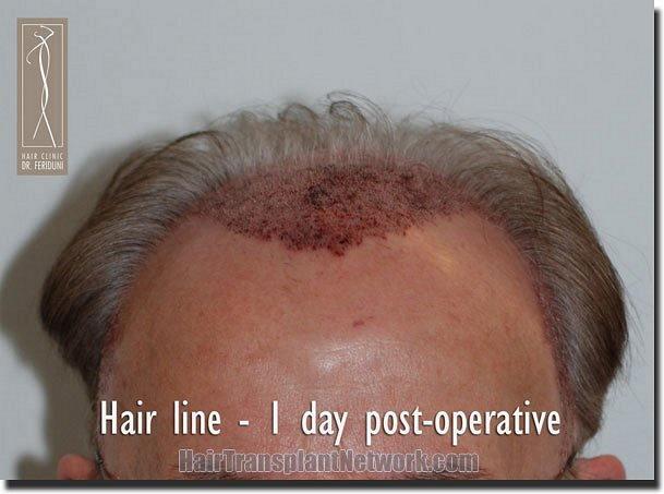 Hair restoration procedure results