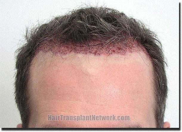 Hair restoration procedure results