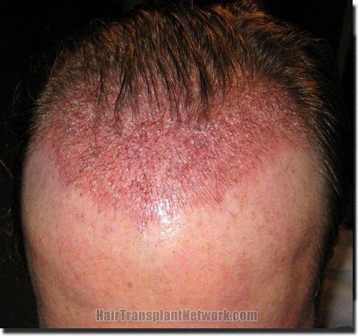 Hair restoration procedure results