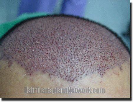 Hair restoration procedure results