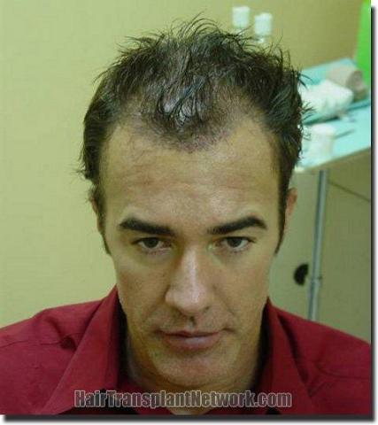 Hair restoration procedure results