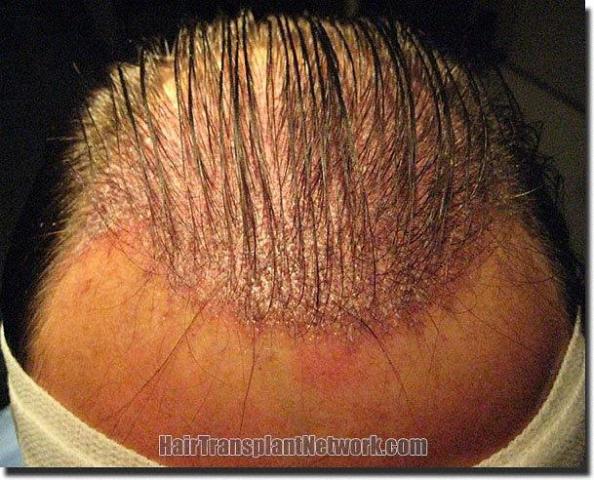 Hair restoration procedure results