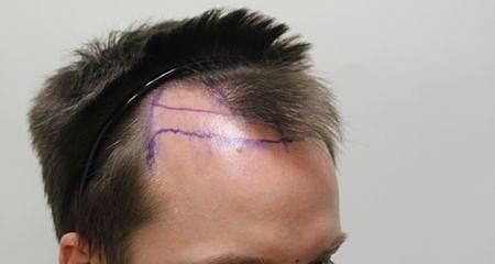 Hair Transplant Network  Where you can find prescreened physicians as  chosen by real patients