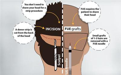 FUE vs FUT Hair Transplant