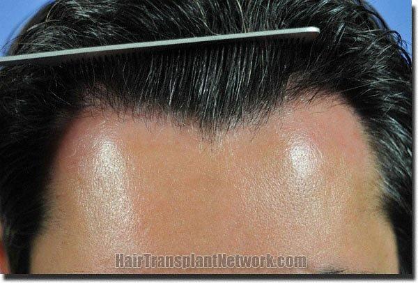 Hair restoration procedure results