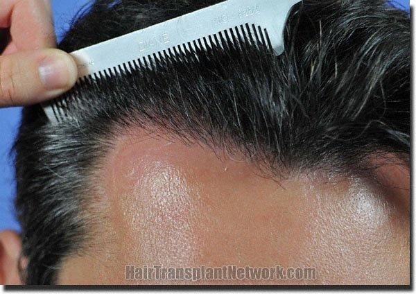 Hair restoration procedure results