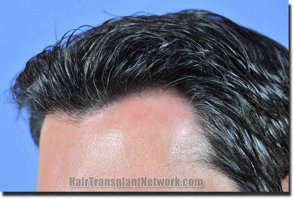 Hair restoration procedure results