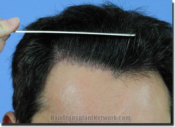 Hair restoration procedure results