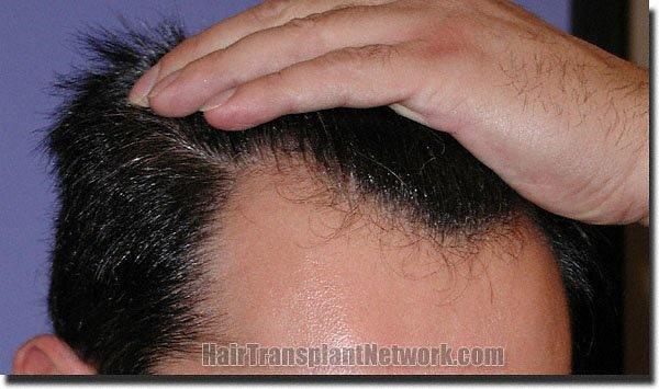 Hair restoration procedure results