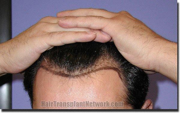 Hair restoration procedure results