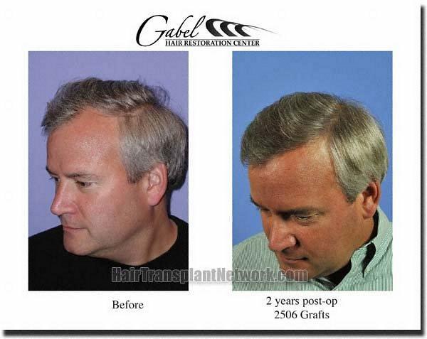 Hair restoration procedure results