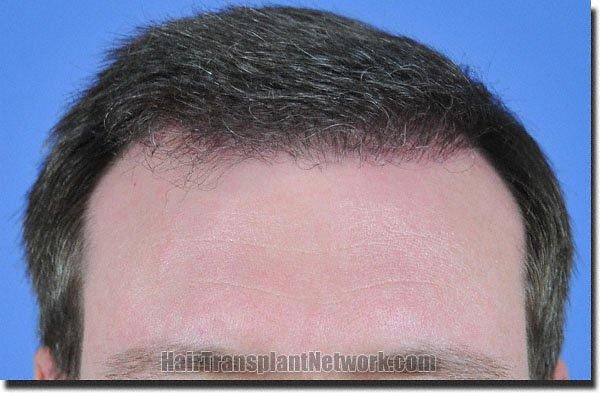 Hair restoration procedure results