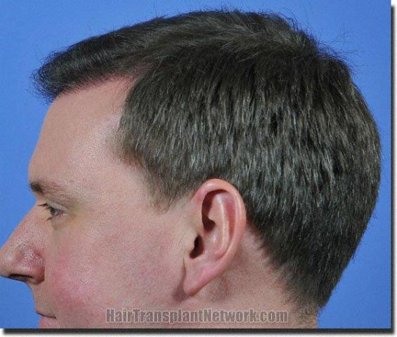 Hair restoration procedure results