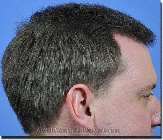 Hair restoration procedure results