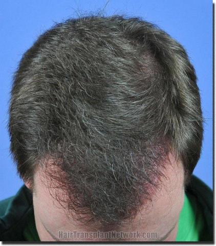 Hair restoration procedure results