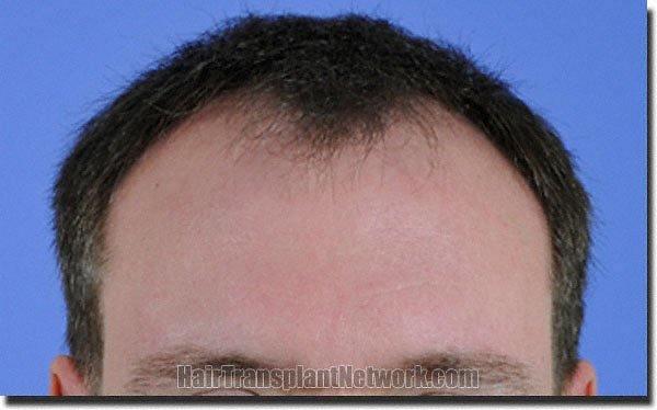 Hair restoration procedure results