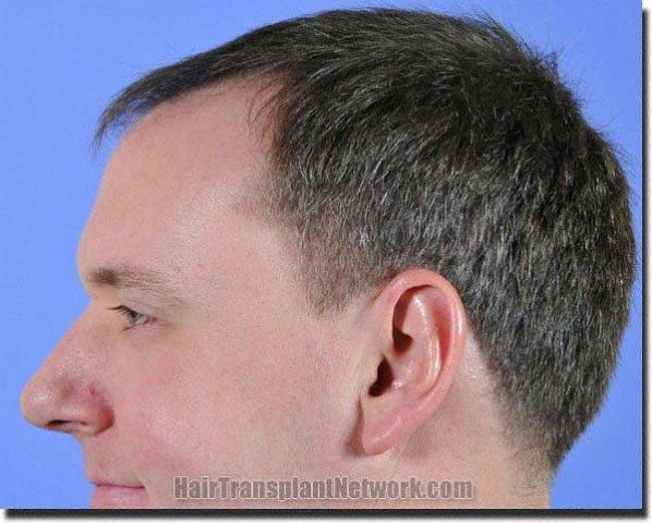 Hair restoration procedure results