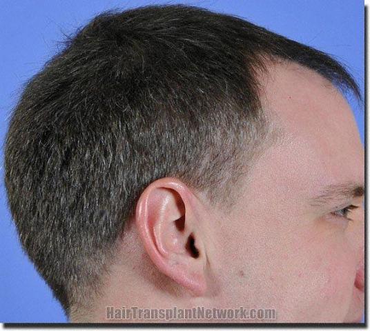 Hair restoration procedure results