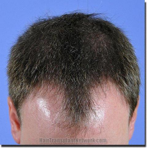 Hair restoration procedure results