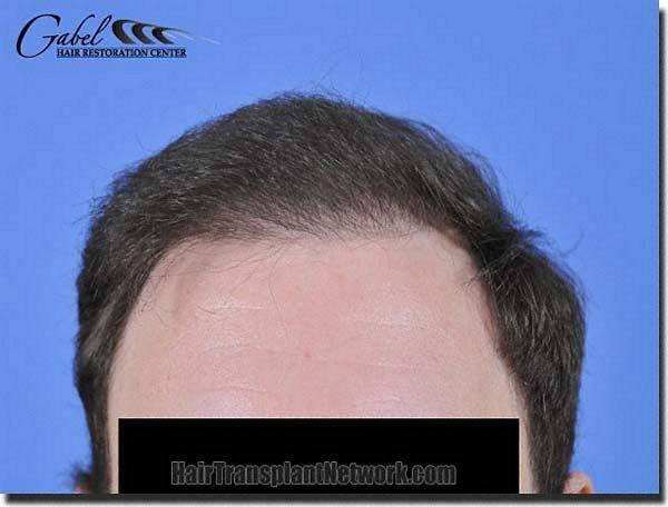 Hair restoration procedure results