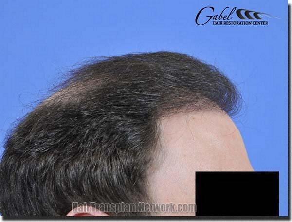 Hair restoration procedure results