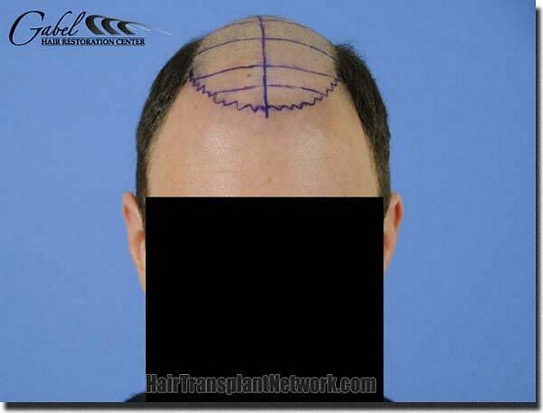 Hair restoration procedure results