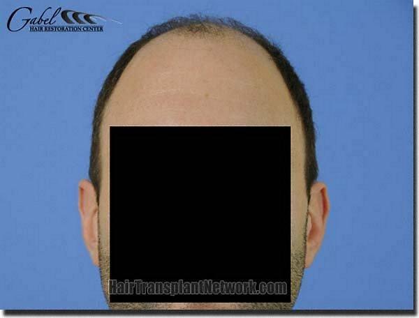 Hair restoration procedure results