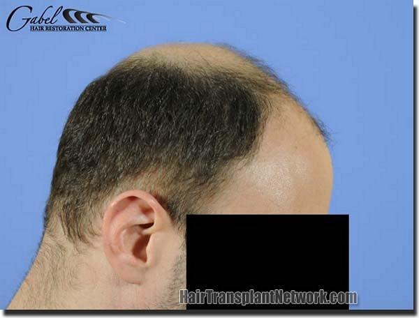 Hair restoration procedure results